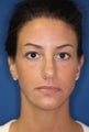 Ear Surgery (Otoplasty)