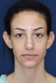 Ear Surgery (Otoplasty)