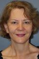 LiteLift™, Blepharoplasty, Brow Lift on 49-year-old Woman