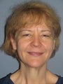 LiteLift™, Blepharoplasty, Brow Lift on 49-year-old Woman