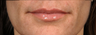 Restylane Lips