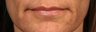 Restylane Lips