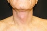 Cervicoplasty