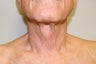 Cervicoplasty