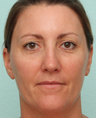 Sciton BroadBand Light (BBL), IPL, MicroLaserPeel