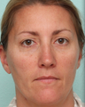 Sciton BroadBand Light (BBL), IPL, MicroLaserPeel