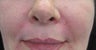 54 year old Female Treatment for Naso-labial fold