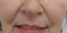 54 year old Female Treatment for Naso-labial fold