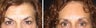 Browlift Before and After