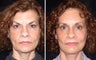 Browlift Before and After