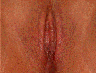 Vaginal Rejuvenation & Labiaplasty