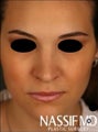 Primary Female Rhinoplasty