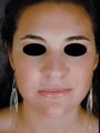 Primary Female Rhinoplasty