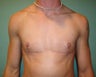 "Top Surgery" FTM chest masculinization