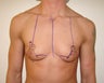 "Top Surgery" FTM chest masculinization