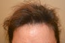 69 year old female treated with Hair Transplant