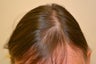 69 year old female treated with Hair Transplant