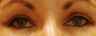 Eyelid Surgery