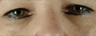 Eyelid Surgery