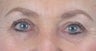Aging Eyelids