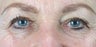 Aging Eyelids
