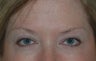 Botox Treatment