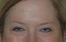 Botox Treatment