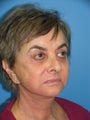 65 yr old woman with Laser Resurfacing