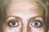 BOTOX