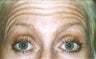BOTOX