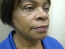 Mini lift providing natural results for an African American female