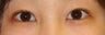 Bilateral Asian Eyelid Surgery