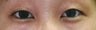 Bilateral Asian Eyelid Surgery