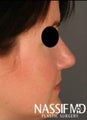 Female Primary Rhinoplasty