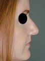 Female Primary Rhinoplasty