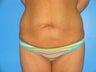 28 yr old woman with body lift