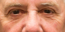 Upper and lower eyelid blepharoplasty