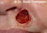 Mohs Reconstruction Surgery
