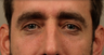 Tear Trough Implants and Restylane plus Dysport to Glabella