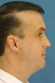 Chin/Neck Liposuction