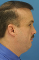 Chin/Neck Liposuction
