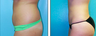 Liposuction Before & After
