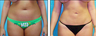 Liposuction Before & After