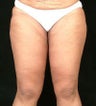 Body Contouring - Thigh lift