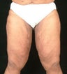 Body Contouring - Thigh lift