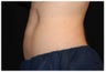 CoolSculpting