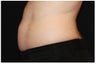 CoolSculpting