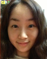 30 year old lady who has undergone forehead & eyebrow lift