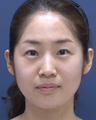 30 year old lady who has undergone forehead & eyebrow lift
