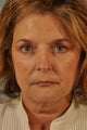 Removal of fat pads and excess tissue around eyes